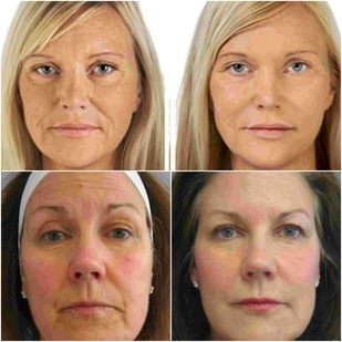 radiofrecuencia facial antes y despues fotos